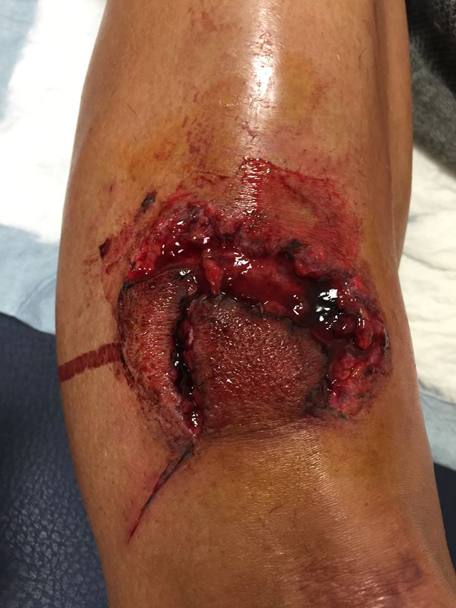 Il ginocchio  di Francisco Ventoso feritosi con i freni a disco nella caduta alla  Parigi Roubaix. Facebook